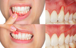 dieu-tri-tut-nuou-tot-nha-o-nha-khoa-hoang-yen-dental