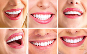 lam-rang-su-tham-my-boc-rang-su-tham-my-tot-nhat-o-nha-khoa-hoang-yen-dental