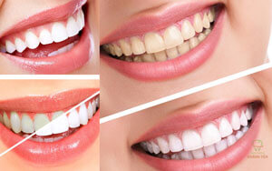 tay-trang-rang-an-toan-nha-khoa-hoang-yen-dental