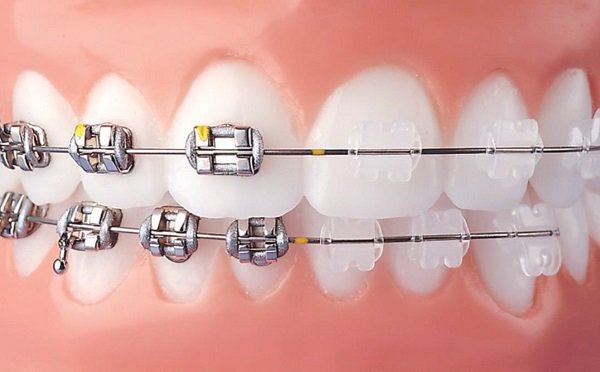 nieng rang mac cai tot nhat tai nha khoa hoang yen dental