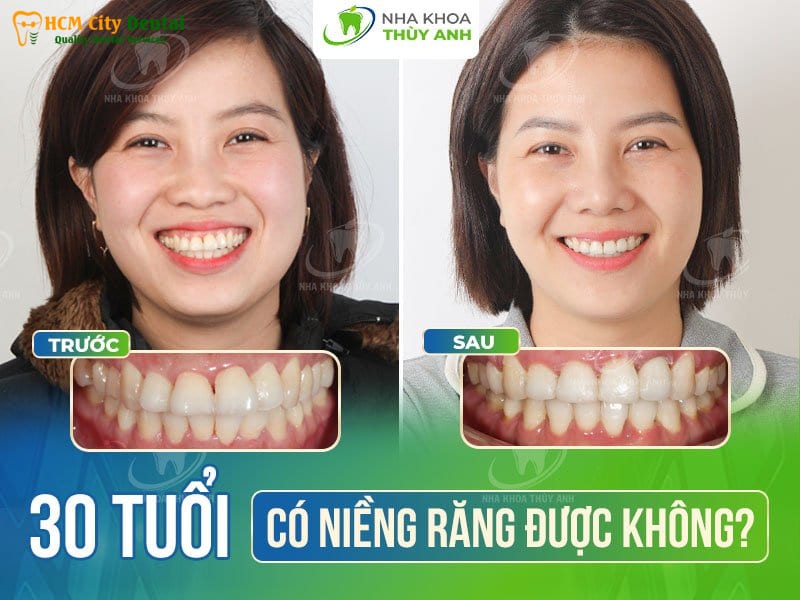 30-tuoi-co-nieng-rang-duoc-khong-2-bac-si-cuong-nha-khoa-bscuong-bac-si-cuong-nha-khoa-bscuong