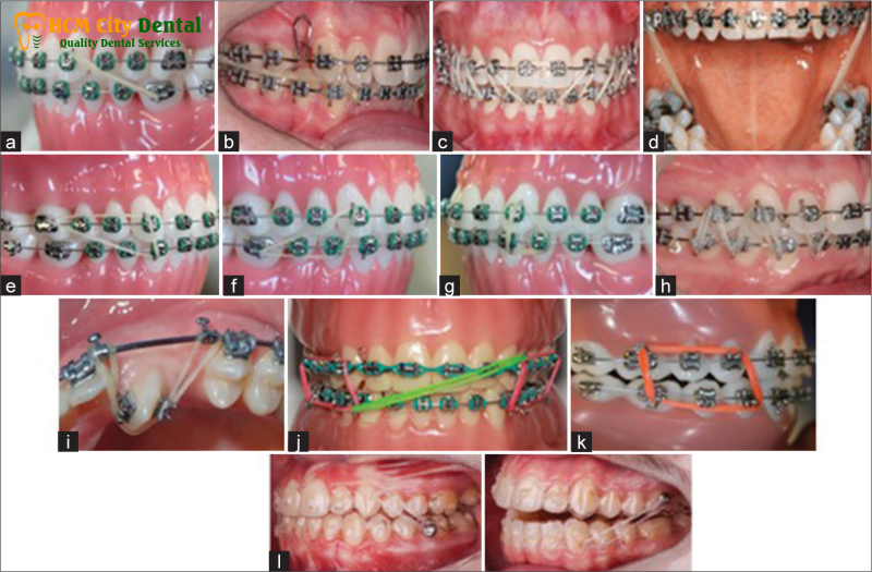 Các loại thun niềng răng: Lựa chọn tốt nhất cho nụ cười của bạn | Bs Cường 3 Cac-loai-thun-nieng-rang-3-bac-si-cuong-nha-khoa-bscuong-bac-si-cuong-nha-khoa-bscuong