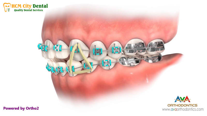 Các loại thun niềng răng: Lựa chọn tốt nhất cho nụ cười của bạn | Bs Cường 5 Cac-loai-thun-nieng-rang-5-bac-si-cuong-nha-khoa-bscuong-bac-si-cuong-nha-khoa-bscuong