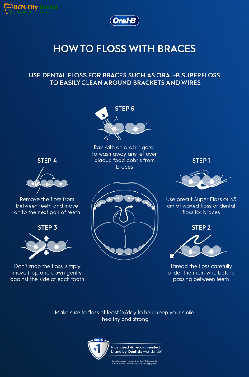 Cach-dung-chi-nha-khoa-khi-nieng-rang-5-bac-si-cuong-nha-khoa-bscuong-bac-si-cuong-nha-khoa-bscuong