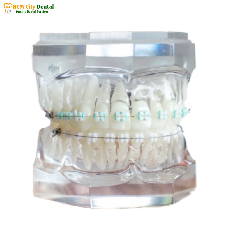 Cong-nghe-nieng-rang-2-bac-si-cuong-nha-khoa-bscuong-bac-si-cuong-nha-khoa-bscuong