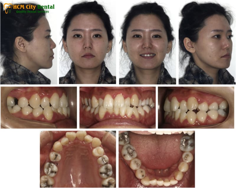 Lech-nhan-trung-khi-nieng-rang-1-bac-si-cuong-nha-khoa-bscuong-bac-si-cuong-nha-khoa-bscuong