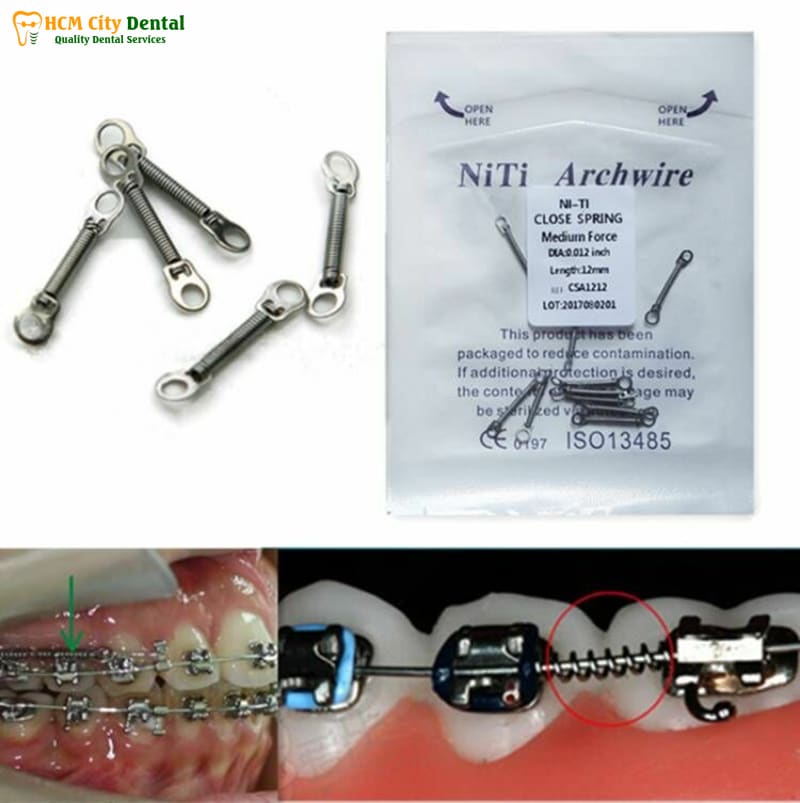 Lo-xo-nieng-rang-6-bac-si-cuong-nha-khoa-bscuong-bac-si-cuong-nha-khoa-bscuong