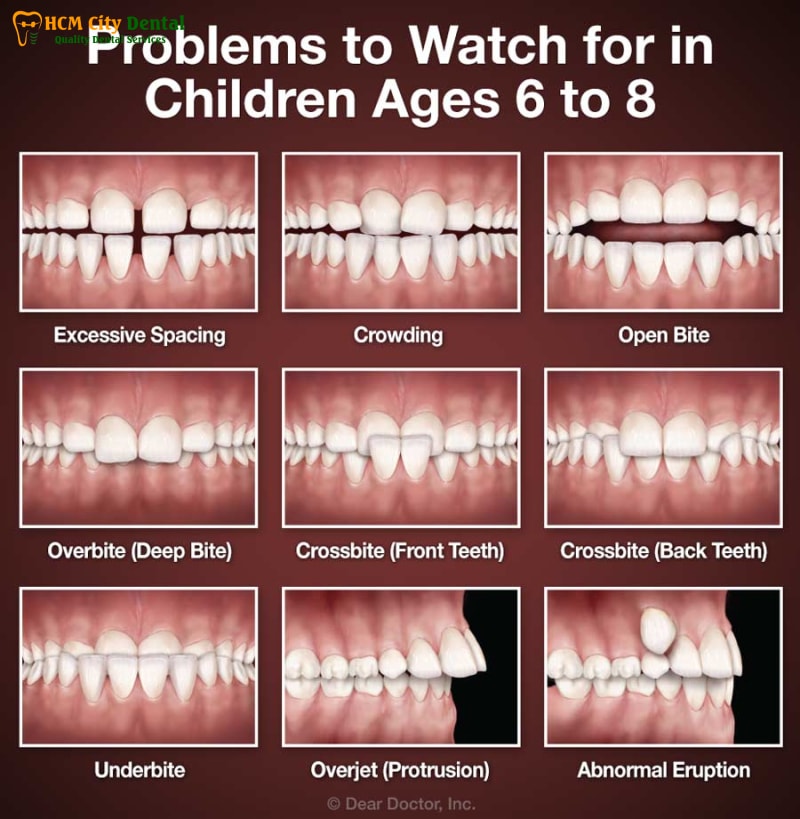 Nhung-dau-hieu-khi-moi-nieng-rang-3-bac-si-cuong-nha-khoa-bscuong-bac-si-cuong-nha-khoa-bscuong
