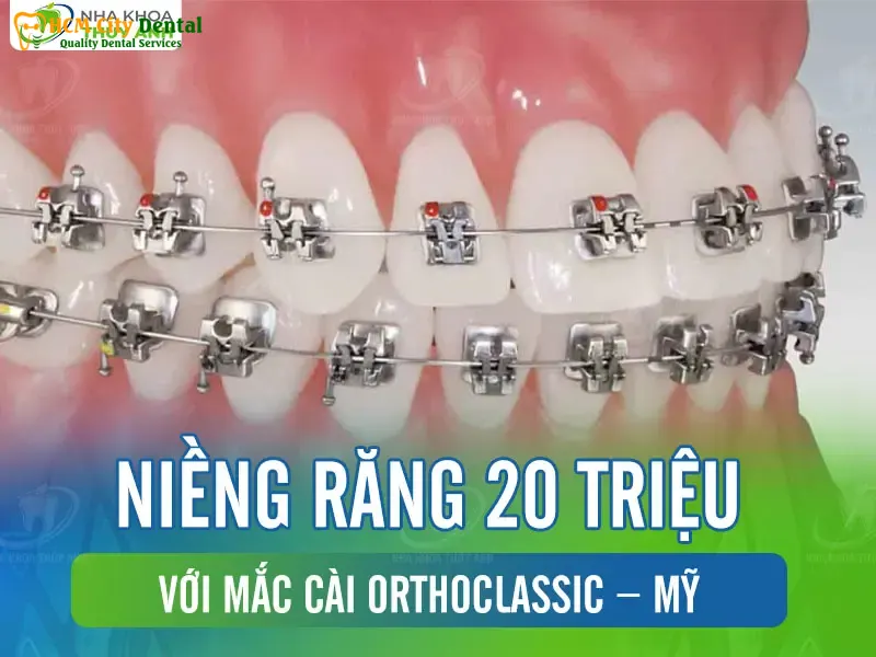 Nieng-rang-20-trieu-1-bac-si-cuong-nha-khoa-bscuong-bac-si-cuong-nha-khoa-bscuong