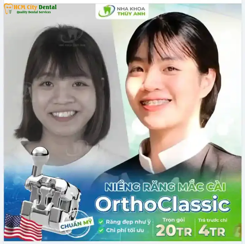 Nieng-rang-20-trieu-6-bac-si-cuong-nha-khoa-bscuong-bac-si-cuong-nha-khoa-bscuong