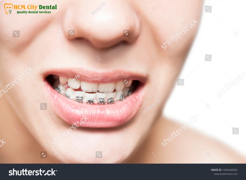 Nieng-rang-ham-duoi-5-bac-si-cuong-nha-khoa-bscuong-bac-si-cuong-nha-khoa-bscuong