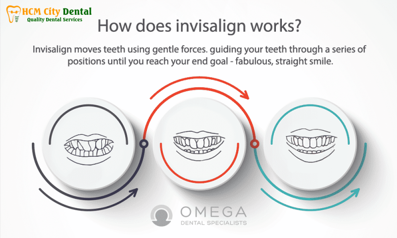 Nieng-rang-invisalign-co-hieu-qua-khong-1-bac-si-cuong-nha-khoa-bscuong-bac-si-cuong-nha-khoa-bscuong