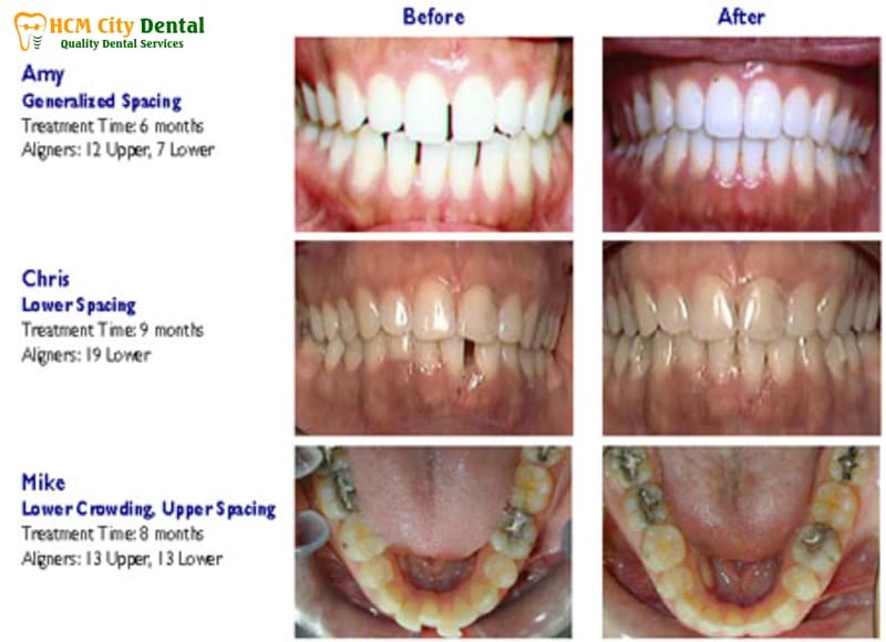Nieng-rang-invisalign-co-hieu-qua-khong-2-bac-si-cuong-nha-khoa-bscuong-bac-si-cuong-nha-khoa-bscuong