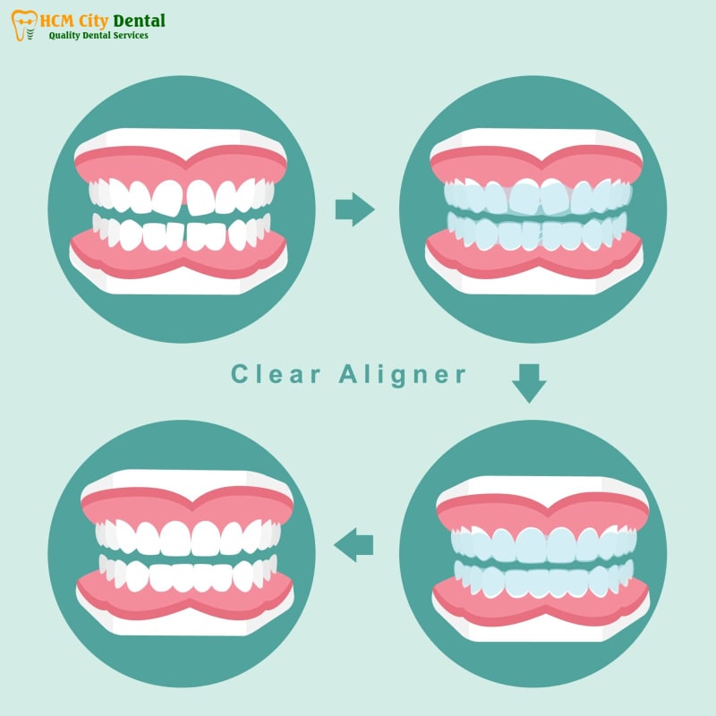 Nieng-rang-invisalign-co-hieu-qua-khong-3-bac-si-cuong-nha-khoa-bscuong-bac-si-cuong-nha-khoa-bscuong