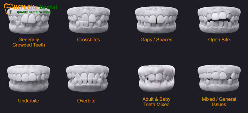 Nieng-rang-invisalign-co-hieu-qua-khong-4-bac-si-cuong-nha-khoa-bscuong-bac-si-cuong-nha-khoa-bscuong