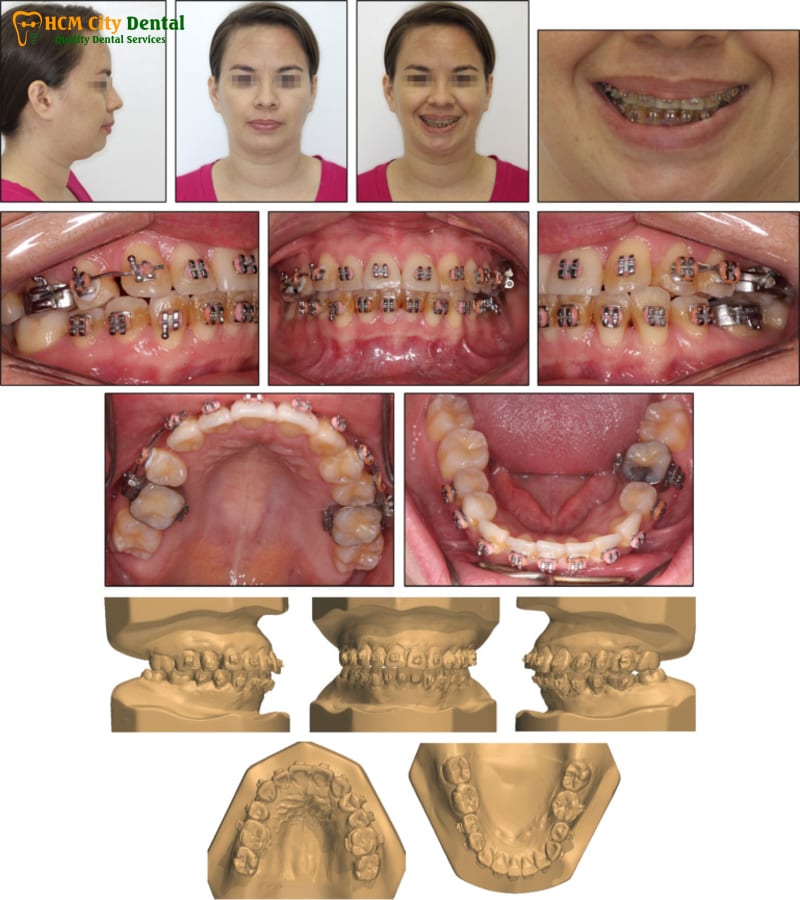Nieng-rang-lan-2-2-bac-si-cuong-nha-khoa-bscuong-bac-si-cuong-nha-khoa-bscuong