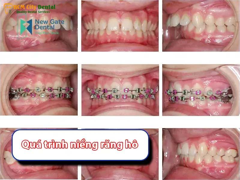 Nieng-rang-tho-4-bac-si-cuong-nha-khoa-bscuong-bac-si-cuong-nha-khoa-bscuong