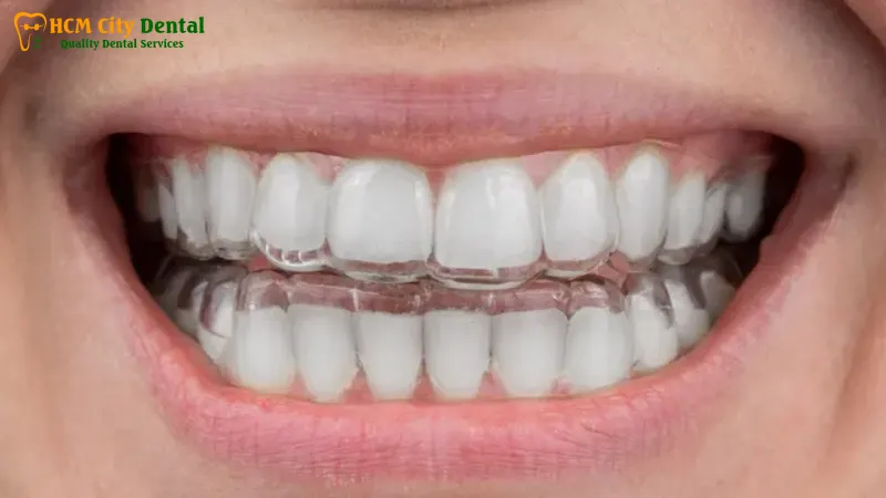 Nieng-rang-trong-suot-clear-aligner-4-bac-si-cuong-nha-khoa-bscuong-bac-si-cuong-nha-khoa-bscuong
