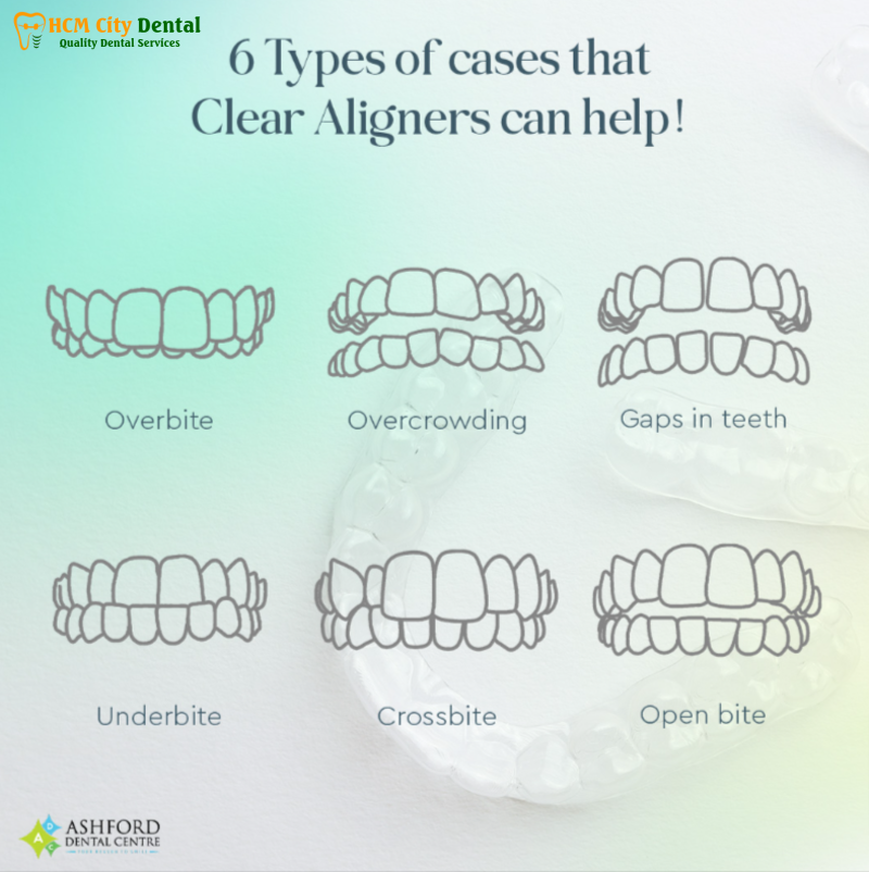 Nieng-rang-trong-suot-clear-aligner-6-bac-si-cuong-nha-khoa-bscuong-bac-si-cuong-nha-khoa-bscuong