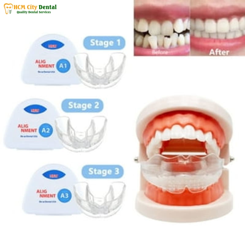 Review-mieng-nieng-rang-silicon-3-bac-si-cuong-nha-khoa-bscuong-bac-si-cuong-nha-khoa-bscuong