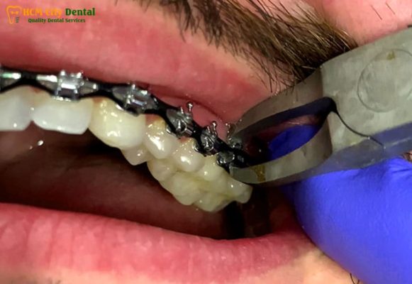 thao-nieng-rang-1-bac-si-cuong-nha-khoa-bscuong