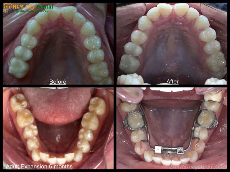 Thao-nieng-rang-2-bac-si-cuong-nha-khoa-bscuong-bac-si-cuong-nha-khoa-bscuong