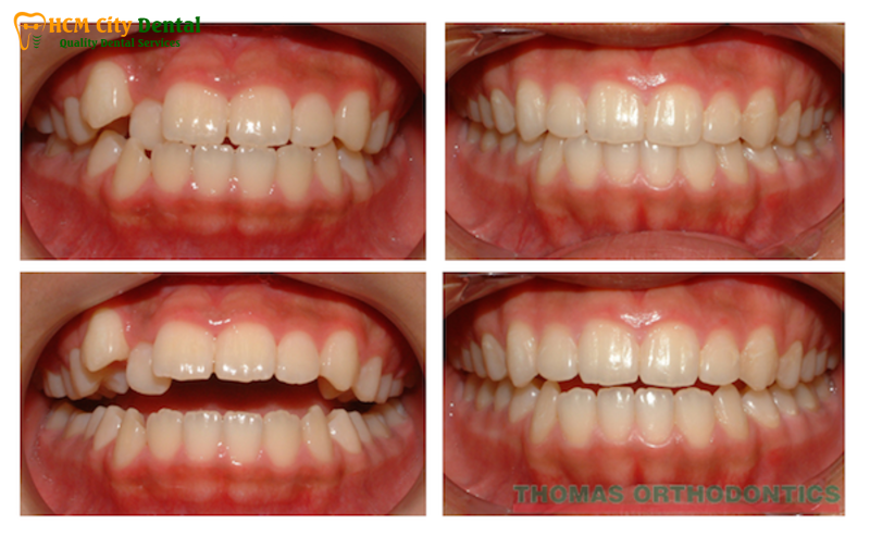 Truoc-va-sau-khi-nieng-rang-1-bac-si-cuong-nha-khoa-bscuong-bac-si-cuong-nha-khoa-bscuong