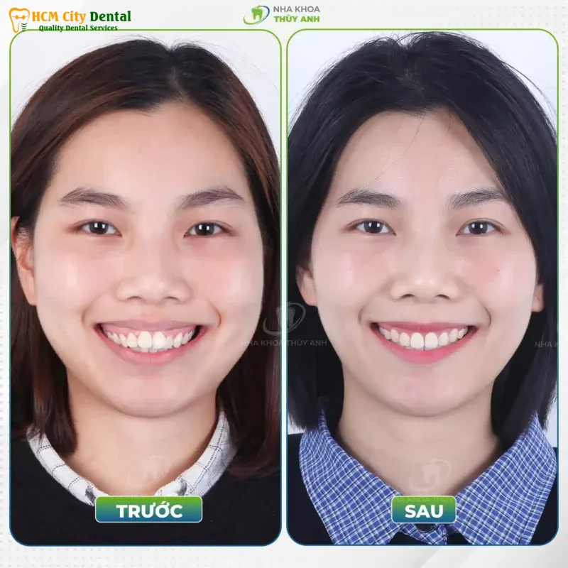 26-tuoi-nieng-rang-duoc-khong-1-bac-si-cuong-nha-khoa-bscuong-bac-si-cuong-nha-khoa-bscuong