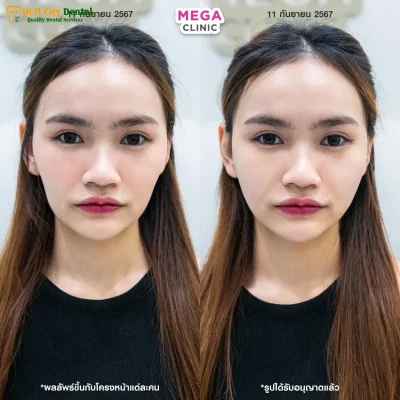 go-ma-cao-co-nen-nieng-rang-1-bac-si-cuong-nha-khoa-bscuong