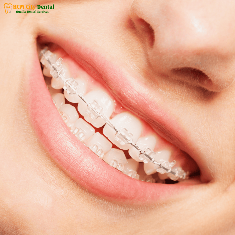 Nieng-rang-clear-aligner-gia-bao-nhieu-3-bac-si-cuong-nha-khoa-bscuong-bac-si-cuong-nha-khoa-bscuong