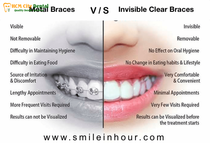 Nieng-rang-clear-aligner-gia-bao-nhieu-5-bac-si-cuong-nha-khoa-bscuong-bac-si-cuong-nha-khoa-bscuong