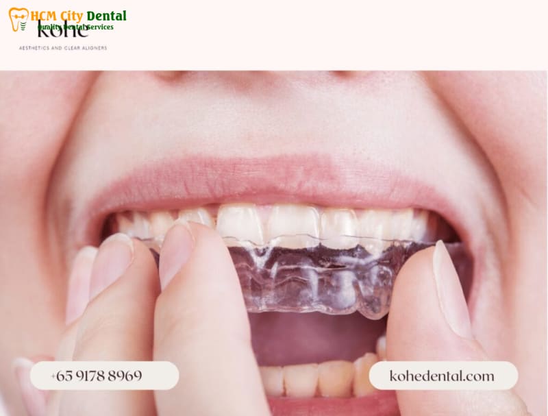 Nieng-rang-clear-aligner-gia-bao-nhieu-6-bac-si-cuong-nha-khoa-bscuong-bac-si-cuong-nha-khoa-bscuong