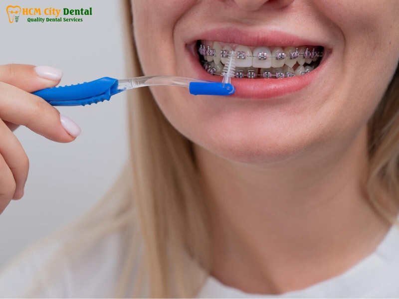 Nieng-rang-co-nen-dung-ban-chai-dien-3-bac-si-cuong-nha-khoa-bscuong-bac-si-cuong-nha-khoa-bscuong