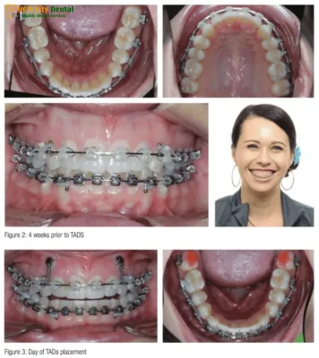nieng-rang-ho-nuou-1-bac-si-cuong-nha-khoa-bscuong