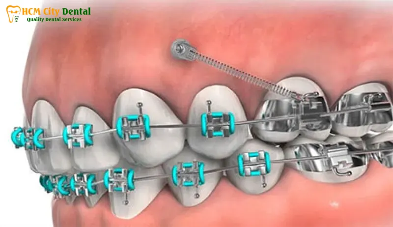 Nieng-rang-implant-1-bac-si-cuong-nha-khoa-bscuong-bac-si-cuong-nha-khoa-bscuong