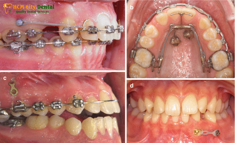 Nieng-rang-implant-2-bac-si-cuong-nha-khoa-bscuong-bac-si-cuong-nha-khoa-bscuong