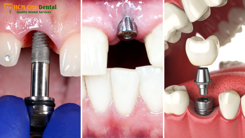 Nieng-rang-implant-3-bac-si-cuong-nha-khoa-bscuong-bac-si-cuong-nha-khoa-bscuong