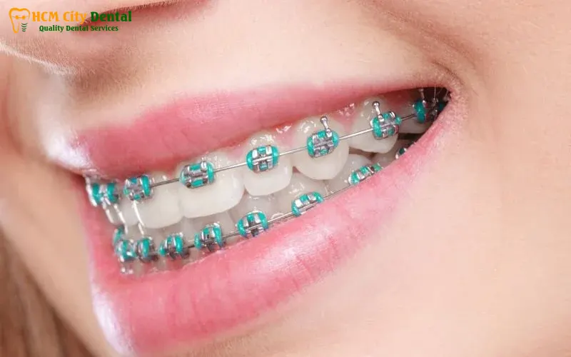 Nieng-rang-mac-cai-sapphire-3-bac-si-cuong-nha-khoa-bscuong-bac-si-cuong-nha-khoa-bscuong