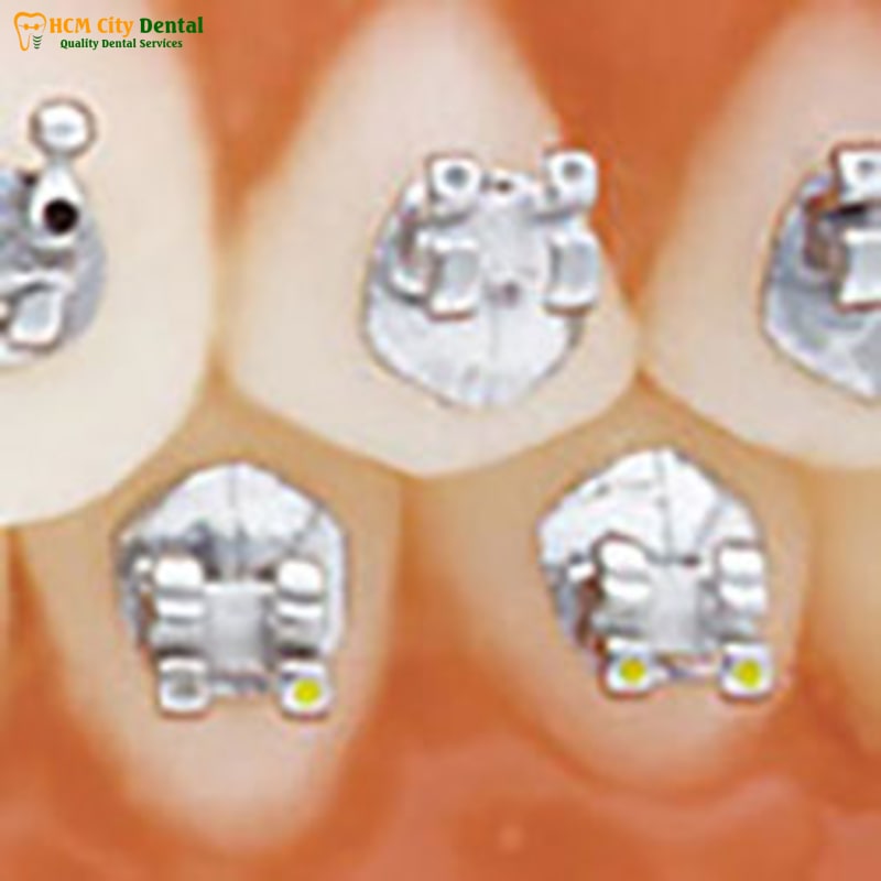 Nieng-rang-mac-cai-titan-5-bac-si-cuong-nha-khoa-bscuong-bac-si-cuong-nha-khoa-bscuong