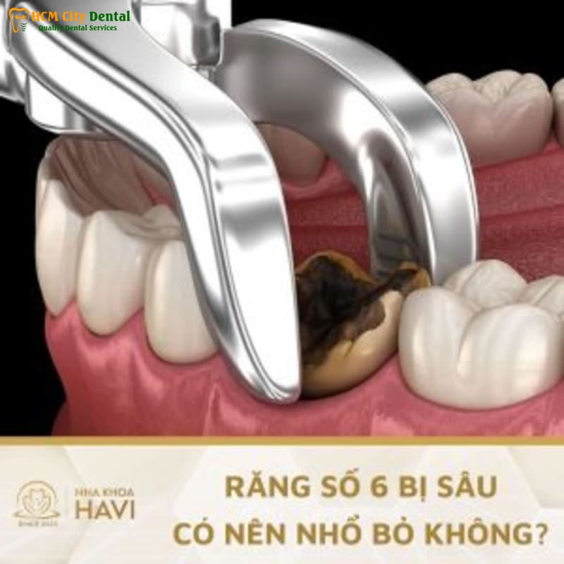 Rang-bi-me-co-nieng-duoc-khong-4-bac-si-cuong-nha-khoa-bscuong-bac-si-cuong-nha-khoa-bscuong